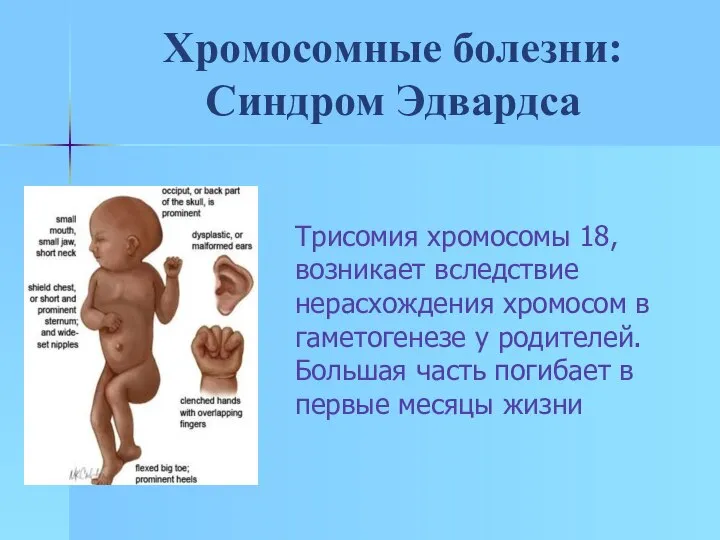 Хромосомные болезни: Синдром Эдвардса Трисомия хромосомы 18, возникает вследствие нерасхождения хромосом