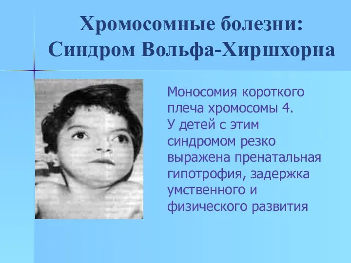 Хромосомные болезни: Синдром Вольфа-Хиршхорна Моносомия короткого плеча хромосомы 4. У детей