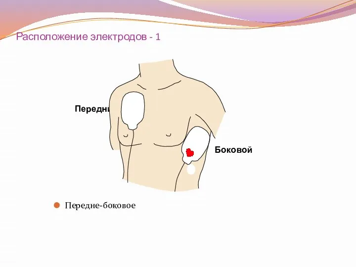 Расположение электродов - 1 Передне-боковое