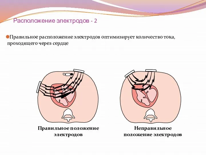 Расположение электродов - 2 Правильное расположение электродов оптимизирует количество тока, проходящего