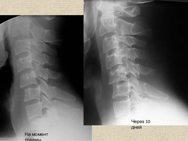 На момент травмы Через 10 дней