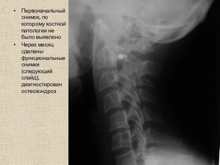 Первоначальный снимок, по которому костной патологии не было выявлено Через месяц