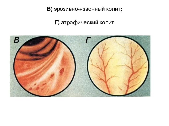 В) эрозивно-язвенный колит; Г) атрофический колит