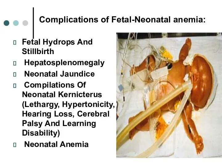 Complications of Fetal-Neonatal anemia: Fetal Hydrops And Stillbirth Hepatosplenomegaly Neonatal Jaundice