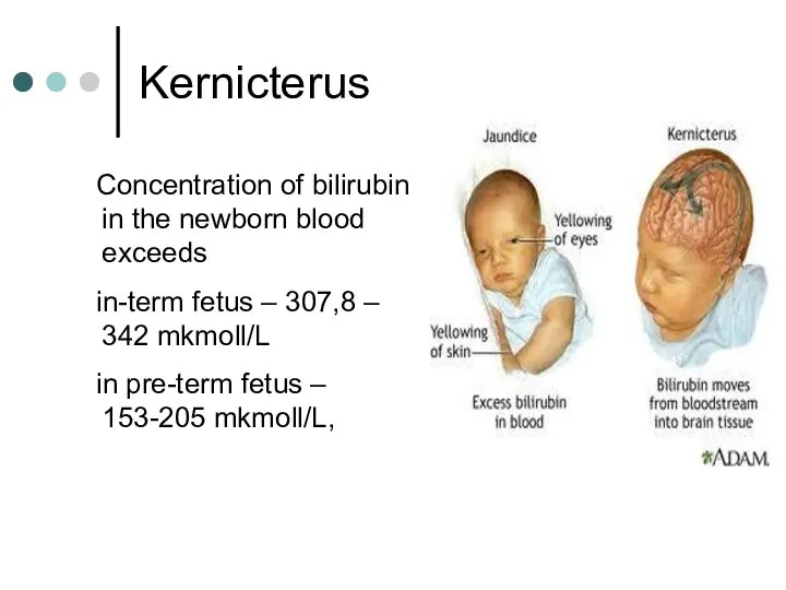 Kernicterus Concentration of bilirubin in the newborn blood exceeds in-term fetus