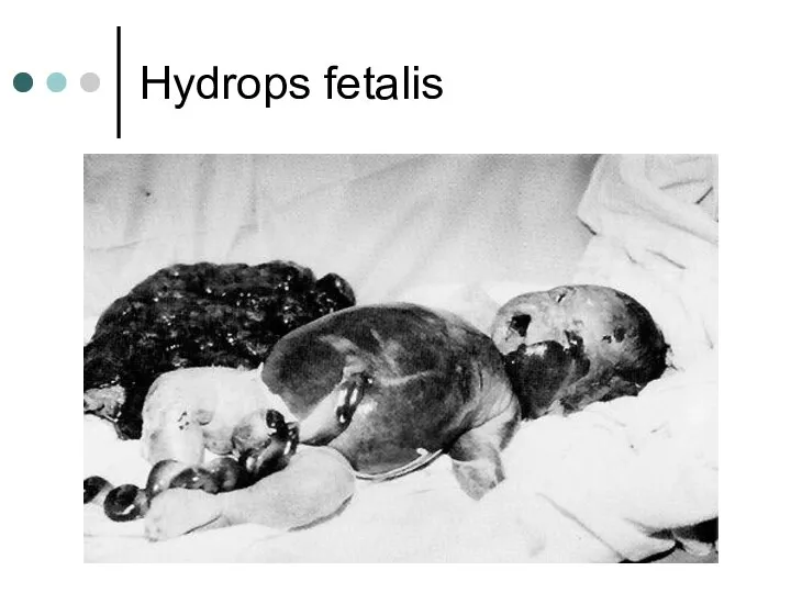 Hydrops fetalis