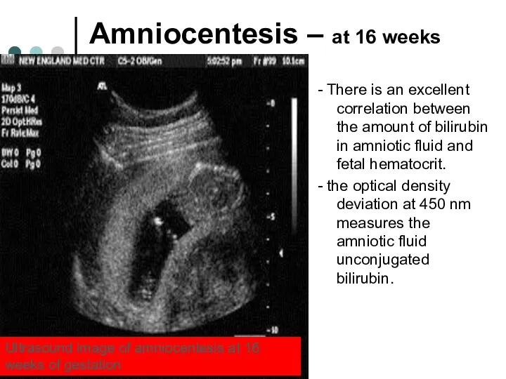 Amniocentesis – at 16 weeks - There is an excellent correlation