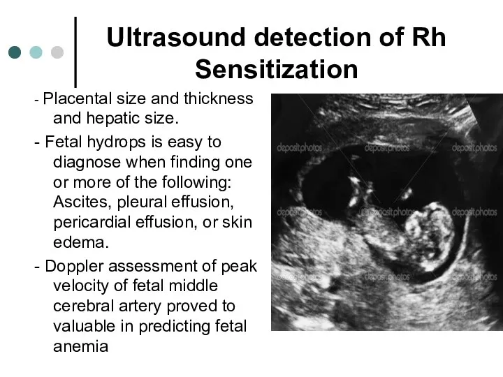 Ultrasound detection of Rh Sensitization - Placental size and thickness and