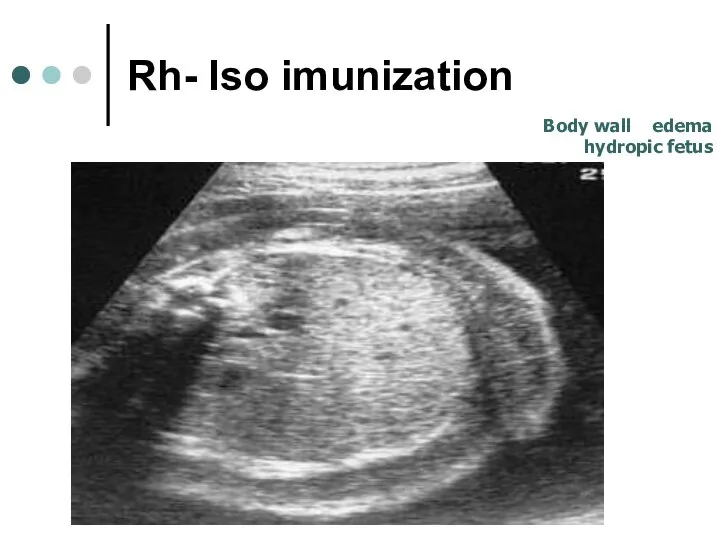Rh- Iso imunization Body wall edema hydropic fetus