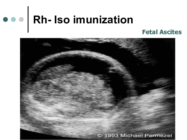 Rh- Iso imunization Fetal Ascites