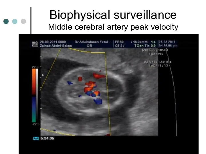 Biophysical surveillance Middle cerebral artery peak velocity