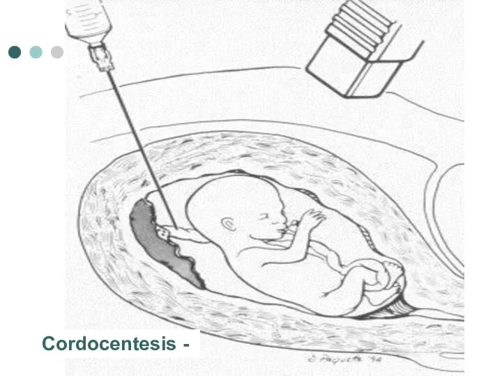 Diagram of cordocentesis procedure Cordocentesis -