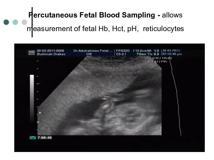Percutaneous Fetal Blood Sampling - allows measurement of fetal Hb, Hct, pH, reticulocytes