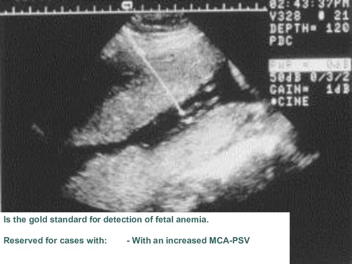 Is the gold standard for detection of fetal anemia. Reserved for