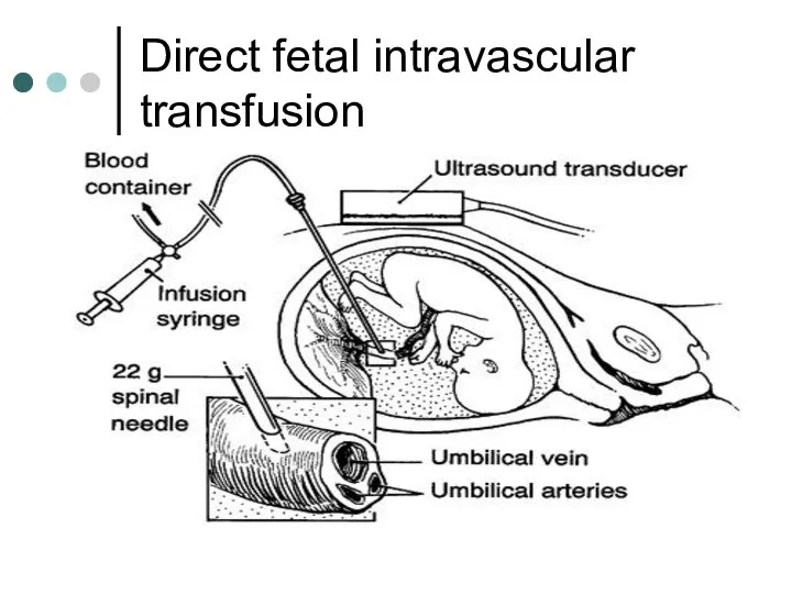 Direct fetal intravascular transfusion