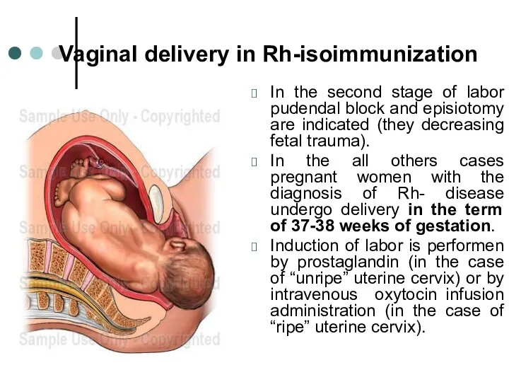 Vaginal delivery in Rh-isoimmunization In the second stage of labor pudendal