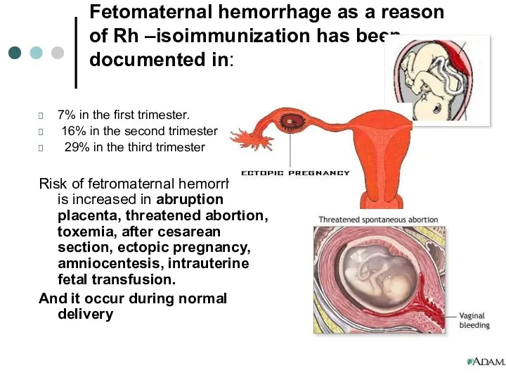 Fetomaternal hemorrhage as a reason of Rh –isoimmunization has been documented