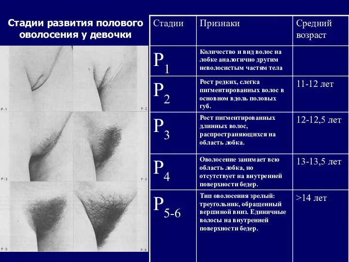 Стадии развития полового оволосения у девочки