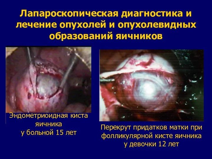 Лапароскопическая диагностика и лечение опухолей и опухолевидных образований яичников Эндометриоидная киста