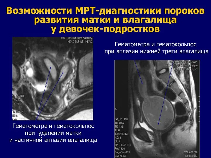 Возможности МРТ-диагностики пороков развития матки и влагалища у девочек-подростков Гематометра и