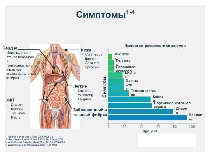 Симптомы1-4 Проценты 1. Pasieka J, et al. Can J Surg. 2001;44:25-32.