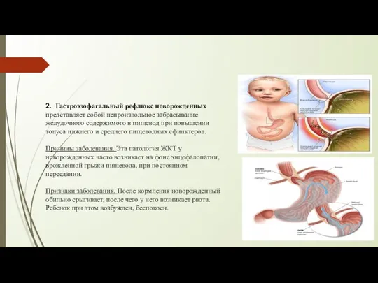 2. Гастроэзофагальный рефлюкс новорожденных представляет собой непроизвольное забрасывание желудочного содержимого в