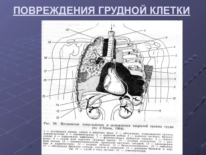 ПОВРЕЖДЕНИЯ ГРУДНОЙ КЛЕТКИ