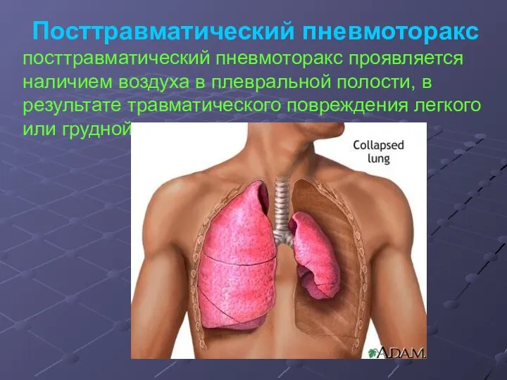 Посттравматический пневмоторакс посттравматический пневмоторакс проявляется наличием воздуха в плевральной полости, в