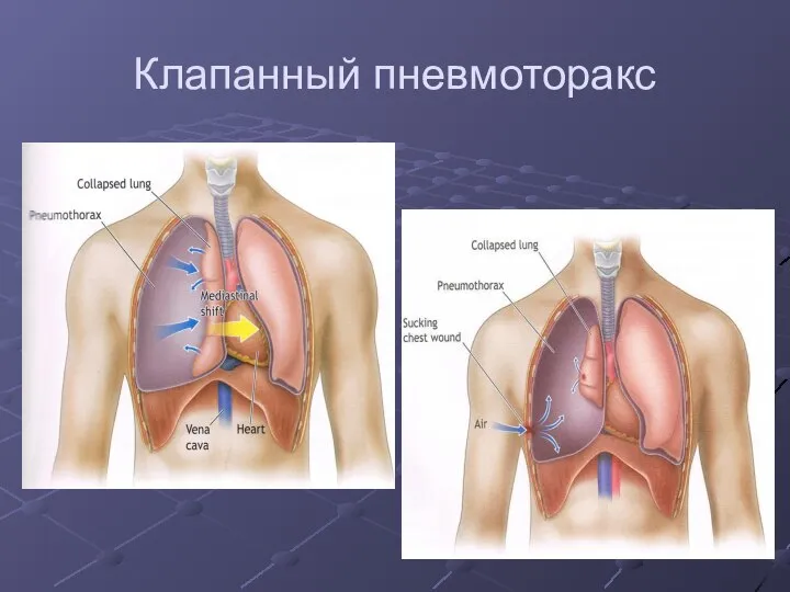 Клапанный пневмоторакс