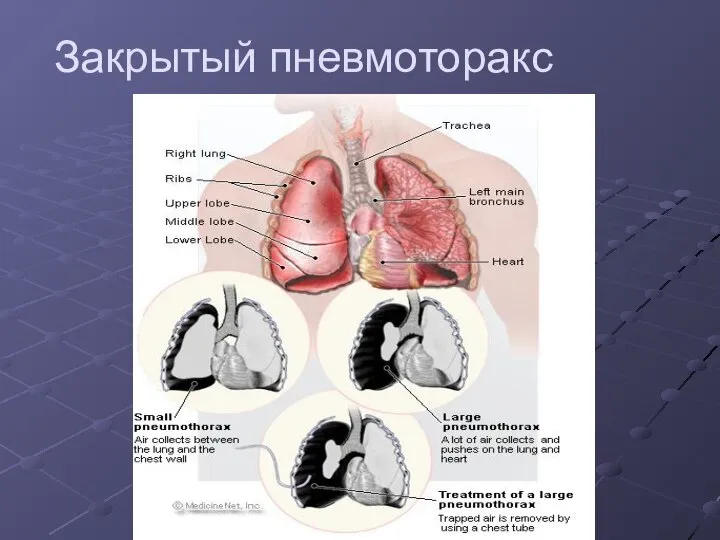 Закрытый пневмоторакс