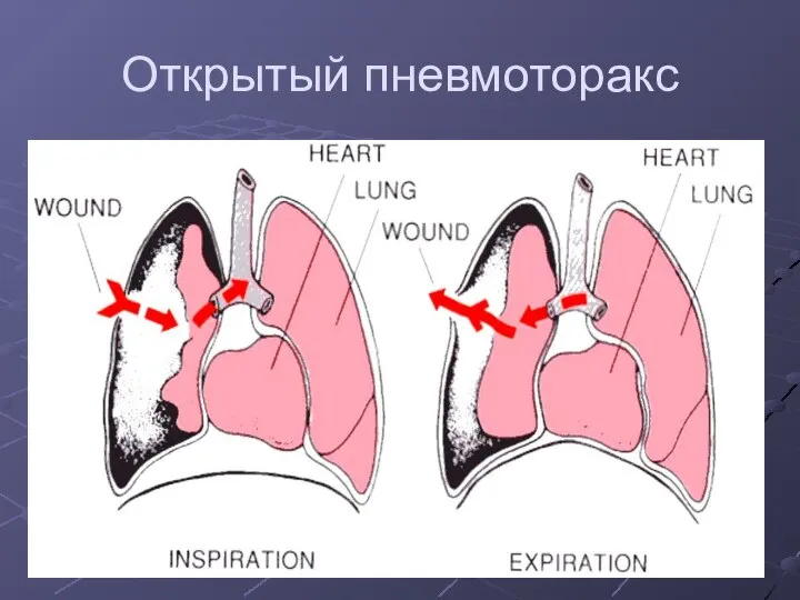 Открытый пневмоторакс