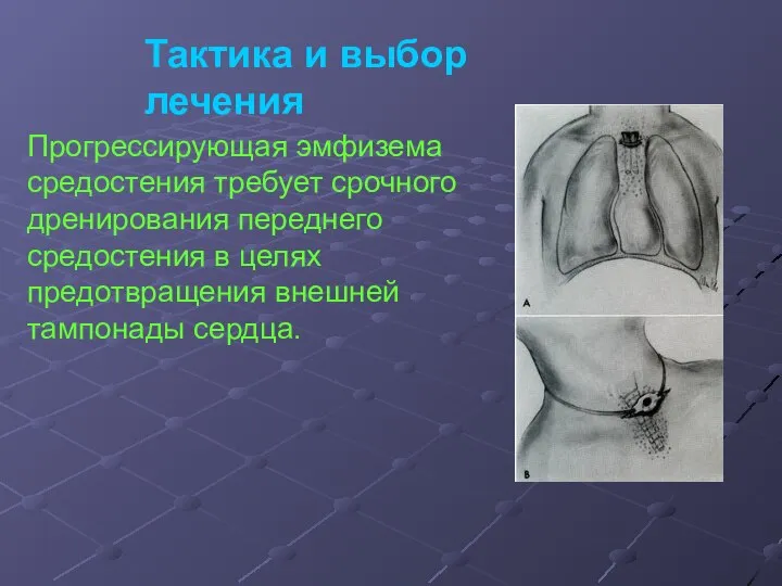 Тактика и выбор лечения Прогрессирующая эмфизема средостения требует срочного дренирования переднего