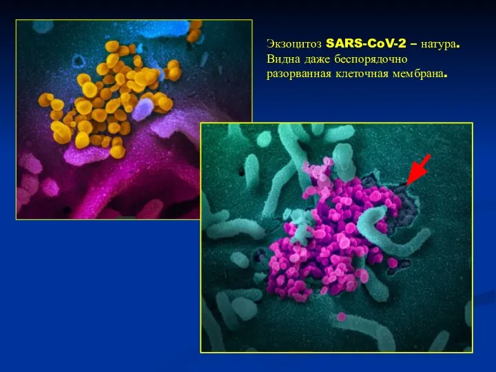 Экзоцитоз SARS-CoV-2 – натура. Видна даже беспорядочно разорванная клеточная мембрана.