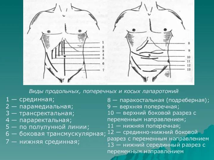 1 — срединная; 2 — парамедиальная; 3 — трансректальная; 4 —