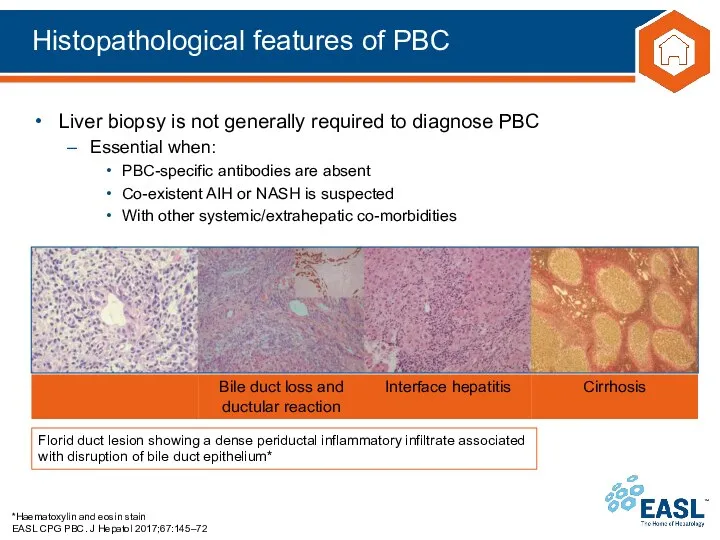 Histopathological features of PBC *Haematoxylin and eosin stain EASL CPG PBC.