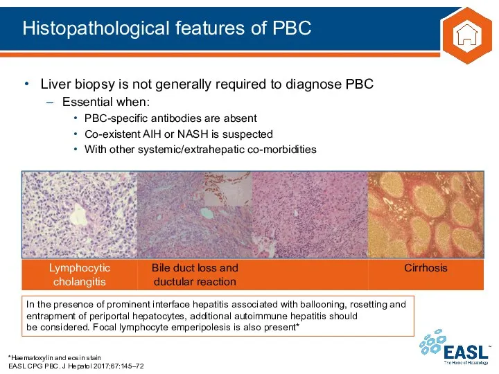 Histopathological features of PBC *Haematoxylin and eosin stain EASL CPG PBC.