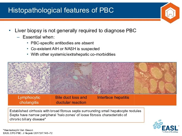 Histopathological features of PBC *Haematoxylin Van Gieson EASL CPG PBC. J