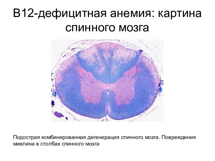 В12-дефицитная анемия: картина спинного мозга Подострая комбинированная дегенерация спинного мозга. Повреждения миелина в столбах спинного мозга