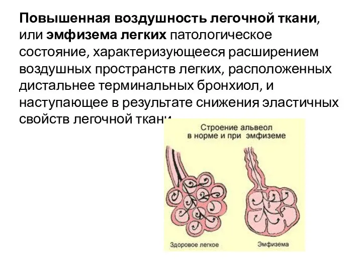 Повышенная воздушность легочной ткани, или эмфизема легких патологическое состояние, характеризующееся расширением