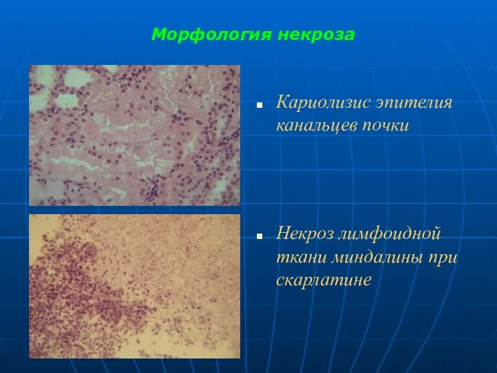 Морфология некроза Кариолизис эпителия канальцев почки Некроз лимфоидной ткани миндалины при скарлатине