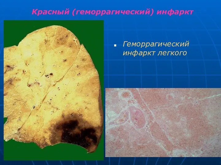 Красный (геморрагический) инфаркт Геморрагический инфаркт легкого