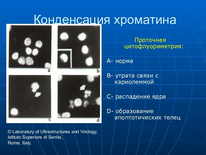 Конденсация хроматина Проточная цитофлуориметрия: A- норма B- утрата связи с кариолеммой