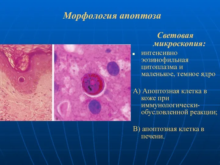 Морфология апоптоза Световая микроскопия: интенсивно эозинофильная цитоплазма и маленькое, темное ядро