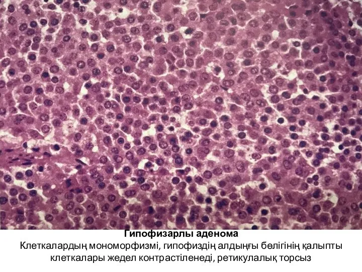 Гипофизарлы аденома Клеткалардың мономорфизмі, гипофиздің алдыңғы бөлігінің қалыпты клеткалары жедел контрастіленеді, ретикулалық торсыз