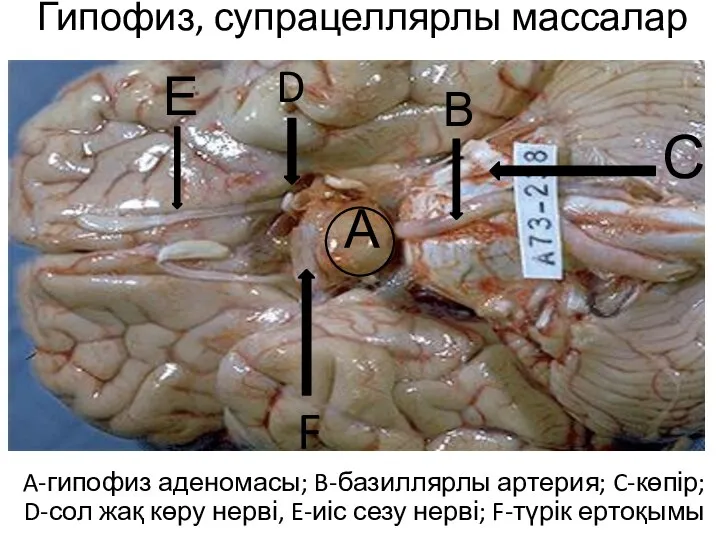 Гипофиз, супрацеллярлы массалар A-гипофиз аденомасы; B-базиллярлы артерия; C-көпір; D-сол жақ көру