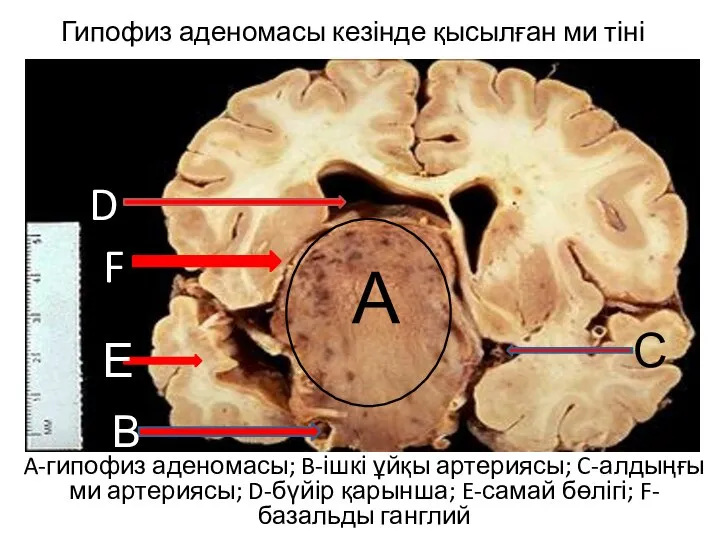 Гипофиз аденомасы кезінде қысылған ми тіні A-гипофиз аденомасы; B-ішкі ұйқы артериясы;