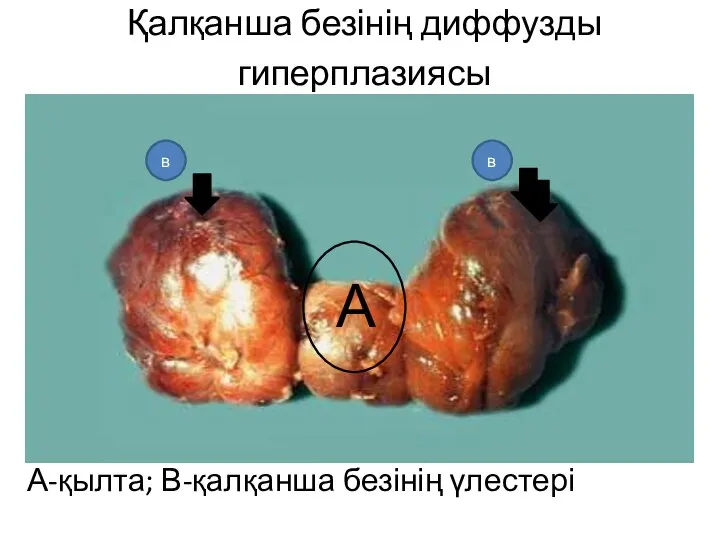 Қалқанша безінің диффузды гиперплазиясы А-қылта; В-қалқанша безінің үлестері А в в