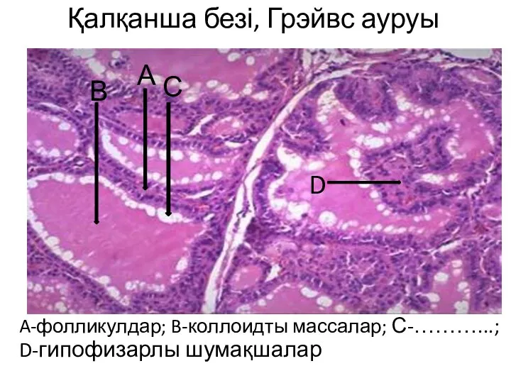 Қалқанша безі, Грэйвс ауруы A-фолликулдар; B-коллоидты массалар; С-………...; D-гипофизарлы шумақшалар В А С D