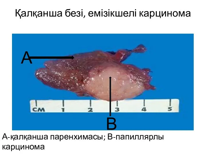 Қалқанша безі, емізікшелі карцинома А-қалқанша паренхимасы; В-папиллярлы карцинома А В