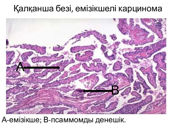 Қалқанша безі, емізікшелі карцинома А-емізікше; В-псаммомды денешік. А В